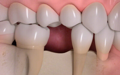 Zahnimplantat oder Brücke? Was ist besser?